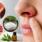 Nasal Vestibulitis Symptoms, Causes and Treatment